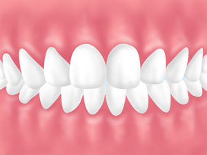 特徴2：咬み合う歯を傷めない